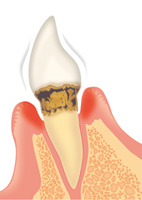 歯周病の進行