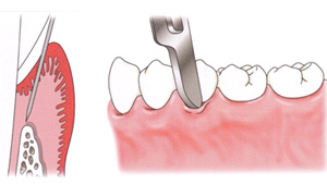 歯周病外科手術