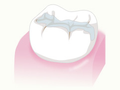 予防歯科メニュー